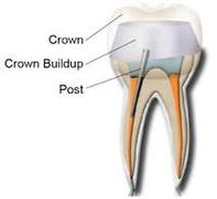 Root Canal Crown build-up