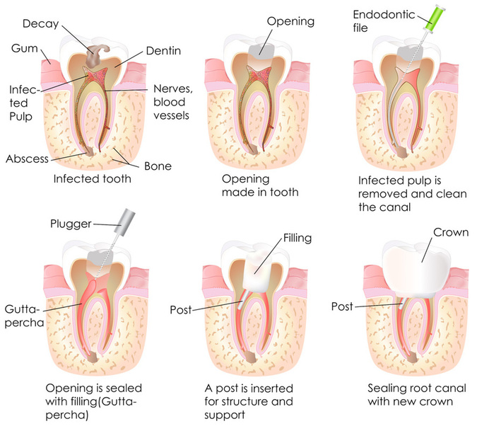 How Root Canal Procedure done?