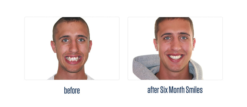 6 month smiles before after